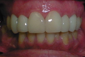 8 Cerinate Veneers